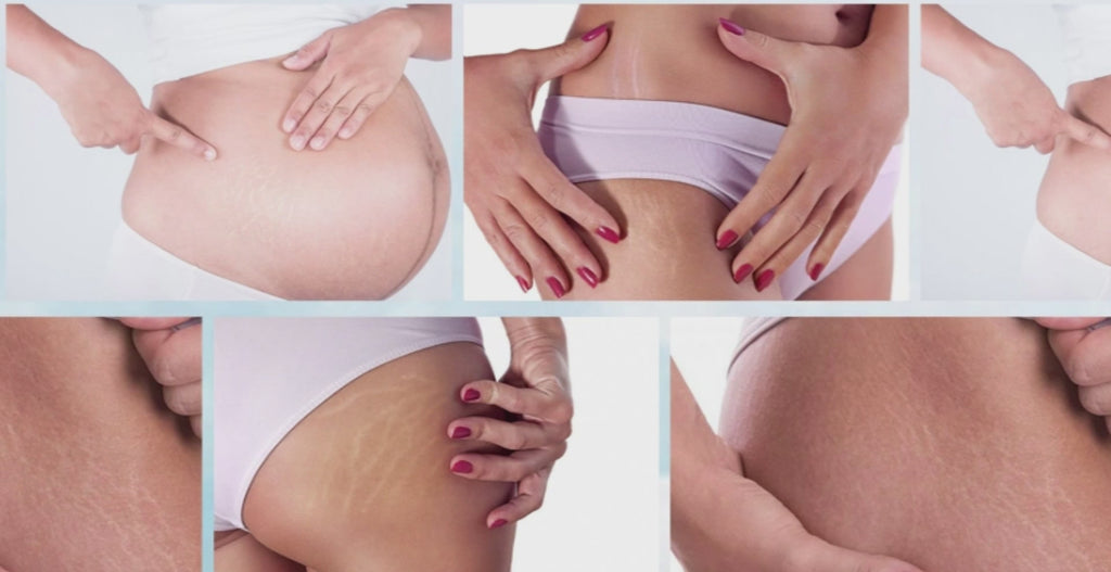 Serum for Scars & Stretch Marks w/ Organic Jojoba Oil & Vitamin E - .34 oz for 2